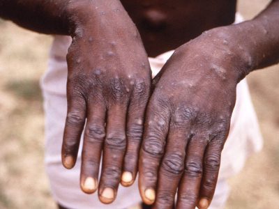 Portugal confirma 5 casos de varíola dos macacos e investiga outros 20