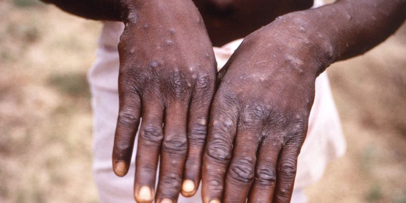 Portugal confirma 5 casos de varíola dos macacos e investiga outros 20