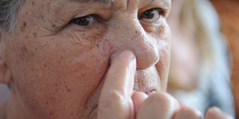 Ministério da Saúde abre consulta sobre diagnóstico do câncer de pele