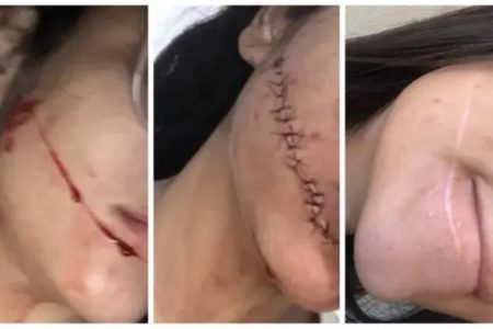 “Não conseguia me olhar no espelho”, diz jovem que teve rosto cortado
