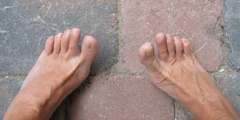 Receitas caseira para unhas encravadas