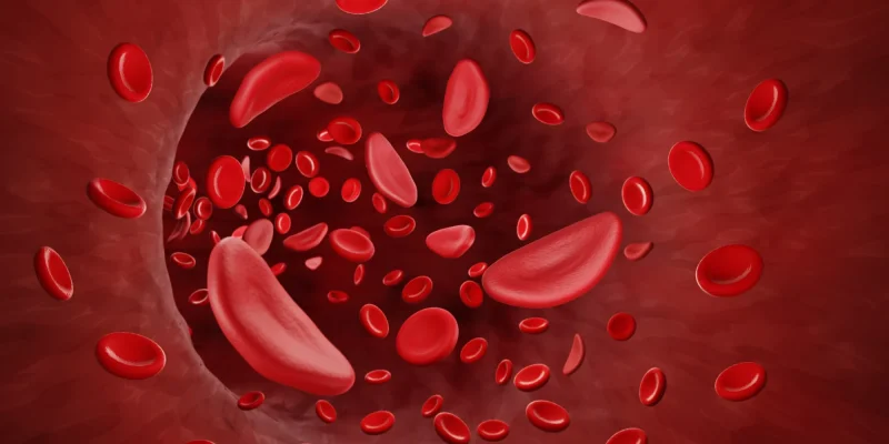 Anemia Falciforme: Sintomas, Tratamentos e Manejo da Qualidade de Vida
