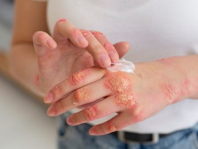 Psoríase: Definição, Sintomatologia, Modalidades Terapêuticas e Prevenção