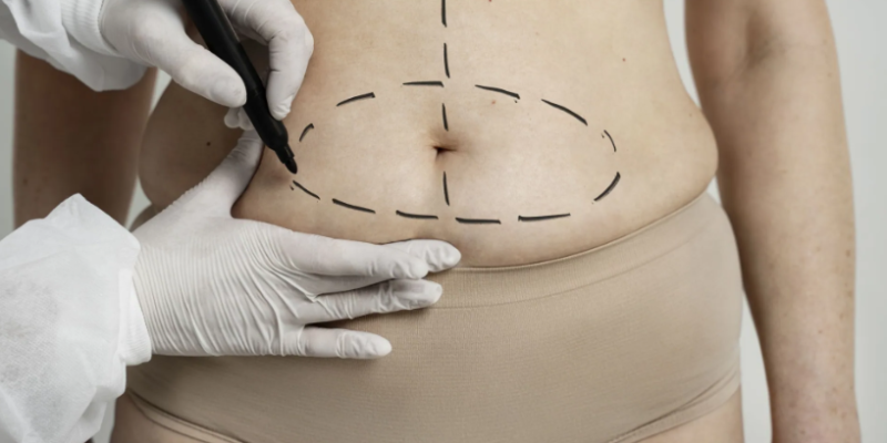 Hidrolipo: Compreenda a Natureza do Procedimento e os Potenciais Riscos Envolvidos