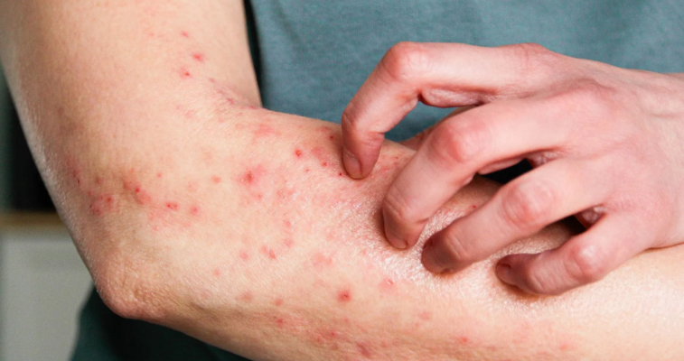 Mpox: Organização Mundial da Saúde Aprova Primeira Vacina para Uso Emergencial em Crianças